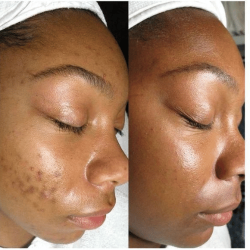 𝐂𝐀𝐑𝐑𝐎𝐓 𝐀𝐒𝐂𝐎𝐑𝐁𝐈𝐂 𝐀𝐂𝐈𝐃 𝐂𝐑𝐄𝐀𝐌.