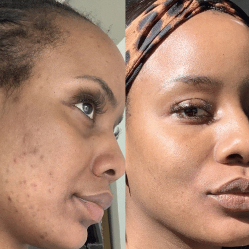 𝐂𝐀𝐑𝐑𝐎𝐓 𝐀𝐒𝐂𝐎𝐑𝐁𝐈𝐂 𝐀𝐂𝐈𝐃 𝐂𝐑𝐄𝐀𝐌.